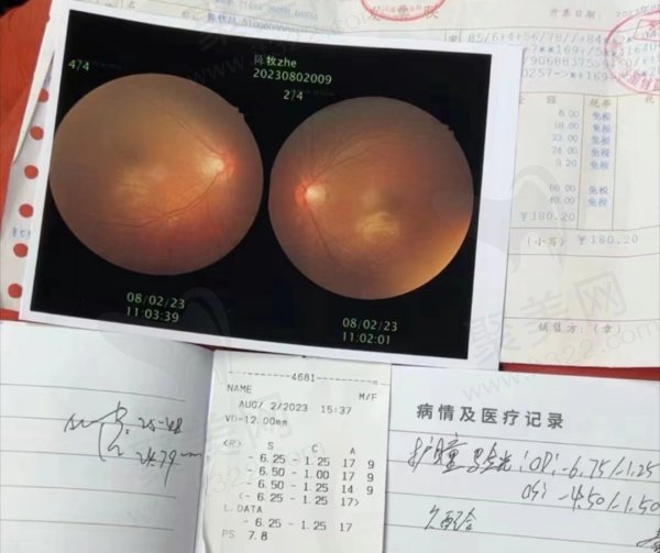 近视手术评价