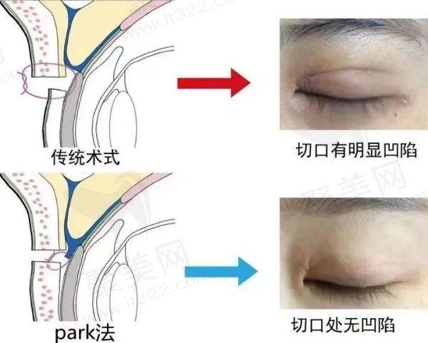 哈尔滨双燕医美滕双艳做双眼皮怎么样
