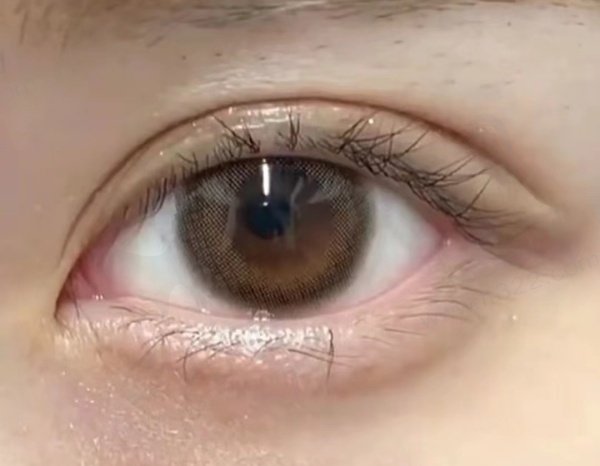 网友双眼皮评价2