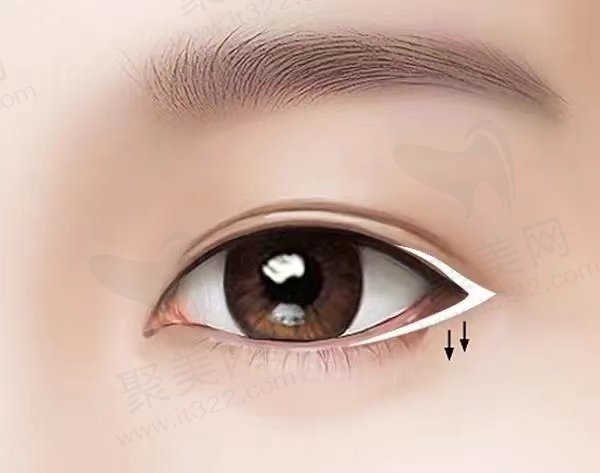 长沙雅美整形眼部整形价格