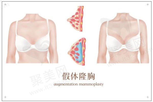 长沙雅美整形胸部整形价格