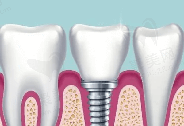 宜春种植牙价格