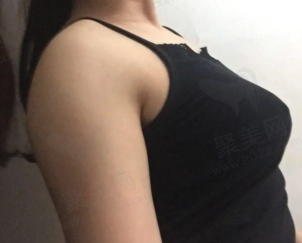 乳房下垂矫正的手术费用和方法