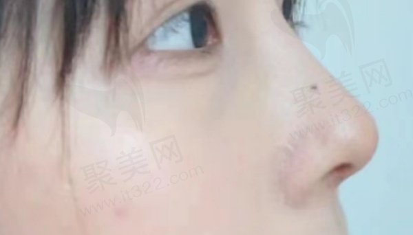 鼻子整形评价2