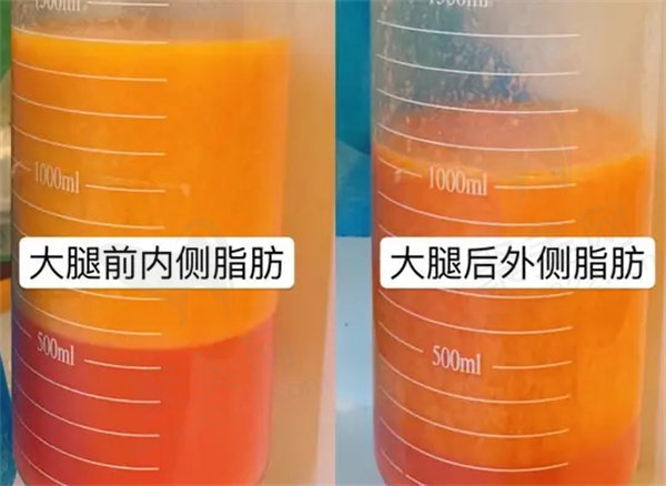多维立体吸脂恢复多久