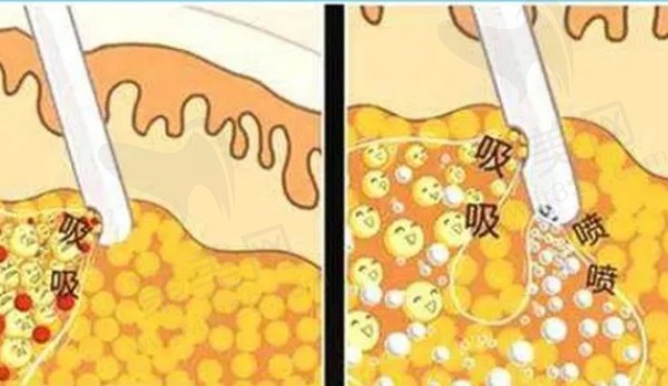 潘红伟吸脂瘦身快速