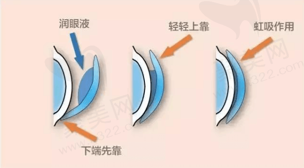角膜塑形镜的疗效