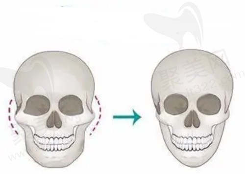 矩形颧骨截骨方式的优势是什么