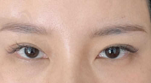 郑永生双眼皮修复实例 郑永生双眼皮修复实例