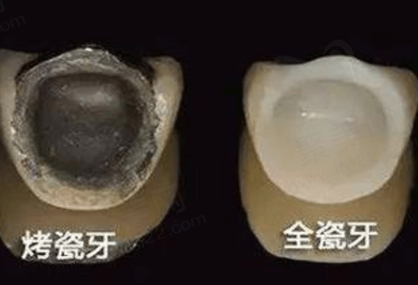 烤瓷牙和全瓷牙的区别