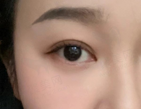 双眼皮评价