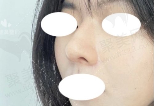 重庆李喆做鼻修复实例