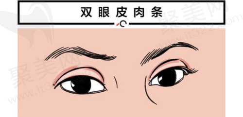王海刚做双眼皮修复价格