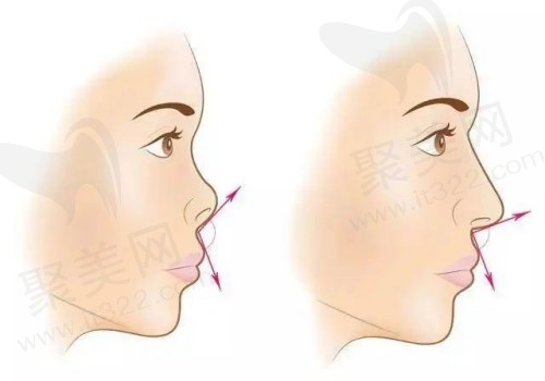 鼻基底填充和法令纹填充有什么区别