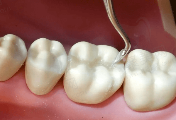 南阳植得口腔X-ONE树脂补牙有什么优势