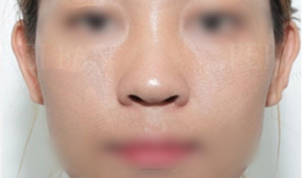 深圳非凡梅够明做鼻子实例
