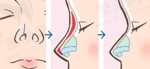 郑州王永功鼻修复技术好
