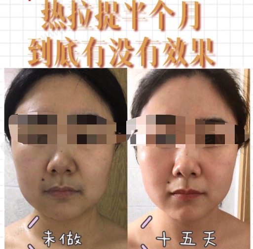 做完热拉提半个月后前后对比图片