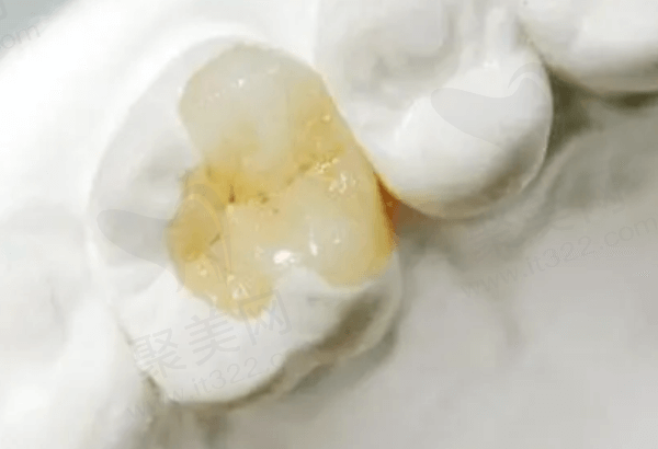 成都极光口腔补牙怎么样