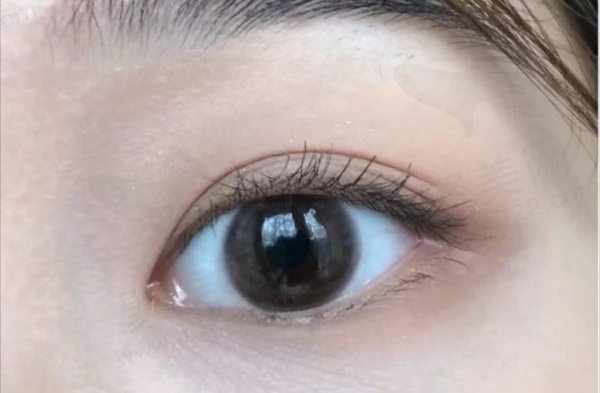 双眼皮评价