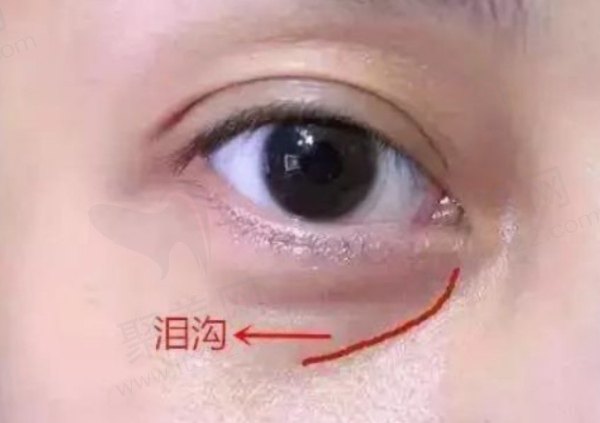 眶隔释放填充泪沟是怎么回事