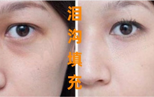 泪沟填充选哪种材料好