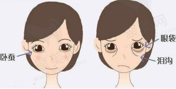泪沟填充玻尿酸填充自体脂肪都可以
