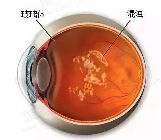 玻璃体混浊会出现哪些症状?