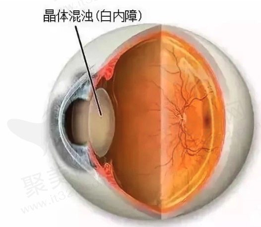 如何治疗玻璃体混浊呢?