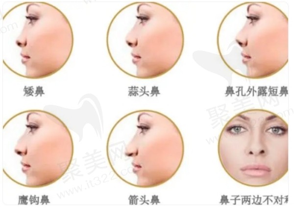 曲梅做鼻子改善问题多
