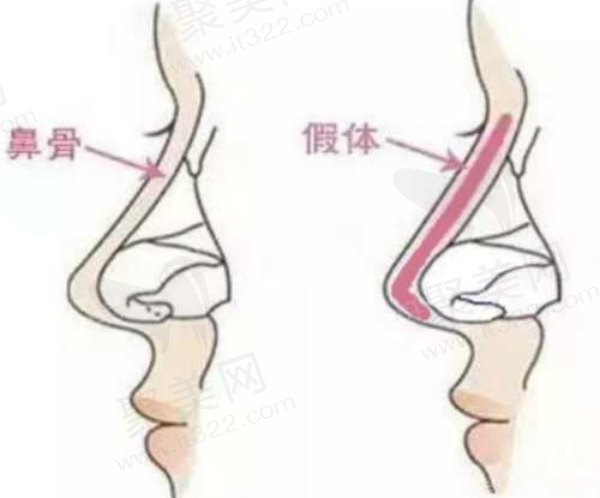 曲梅做原生美鼻采用先进麻醉技术