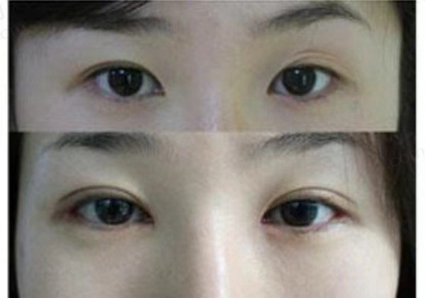 双眼皮整形对比图