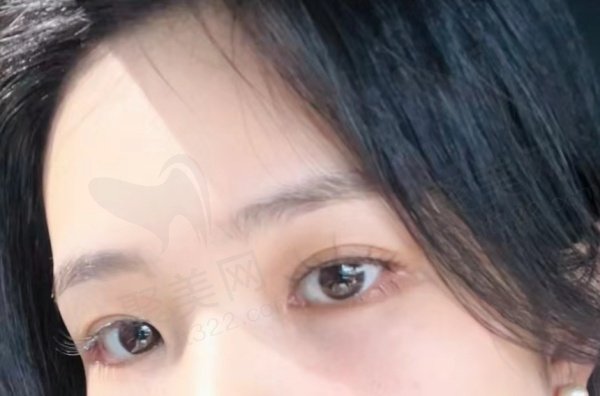 双眼皮评价