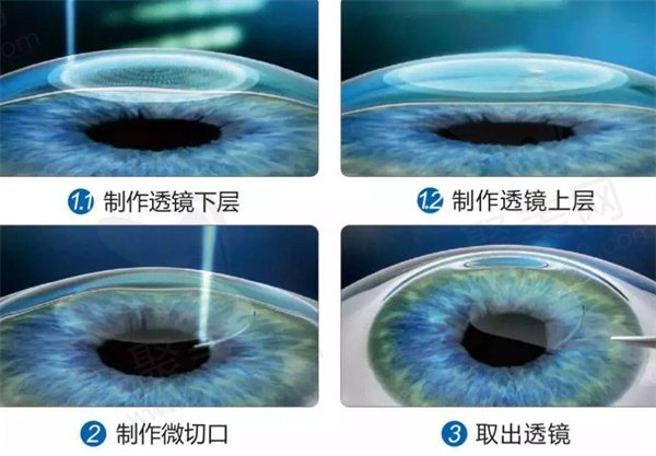 半飞秒激光手术后还会近视吗？