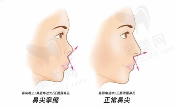 张国强医生做鼻子技术优势
