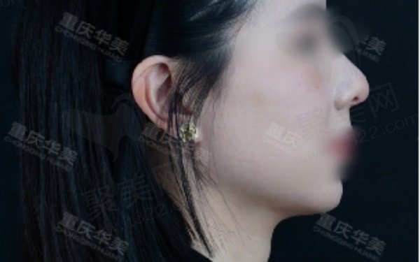 张国强医生做鼻修复实例