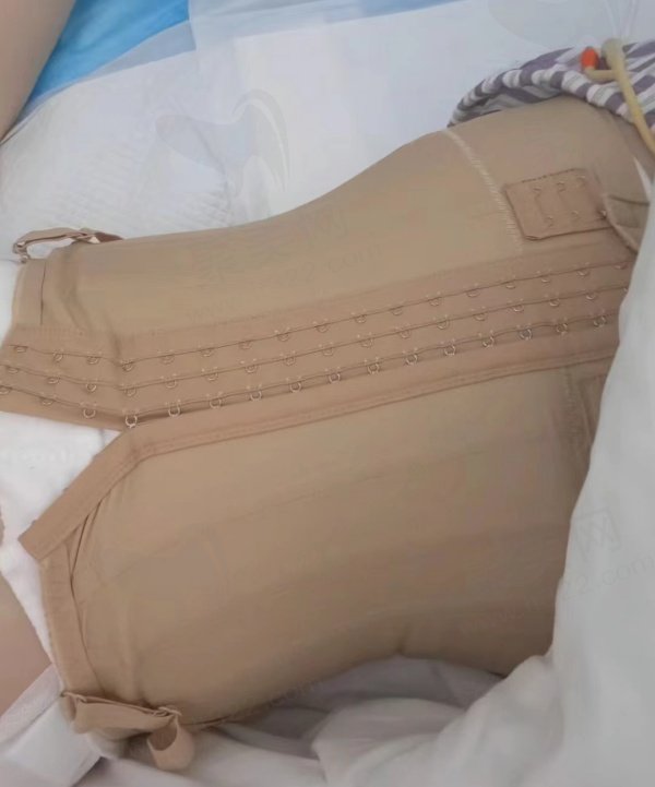 吸脂评价
