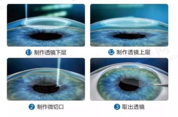 深圳激光类近视手术价格