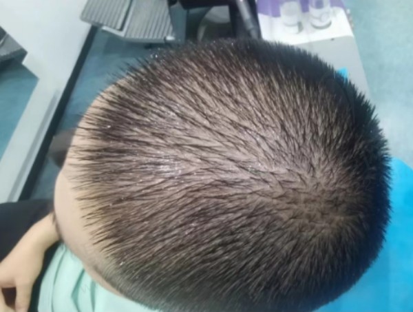 广州倍生植发技术好