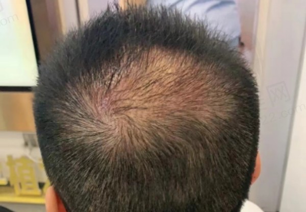 倍生植发廖俊医生植发技术好