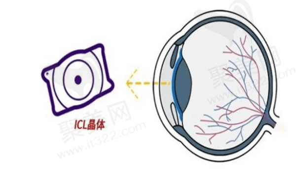 广州爱尔眼科医院ICL晶体植入价格30000元起