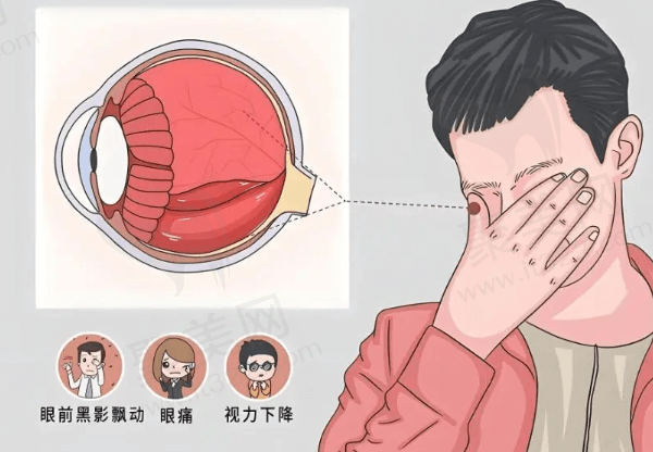 玻璃体后脱离会失明吗？