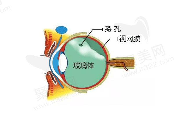 如何治疗玻璃体后脱离呢？ 