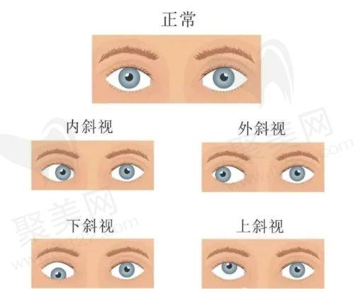 河北省眼科医院韩惠芳治疗斜视怎么样