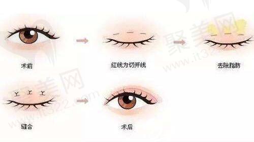 郑州美菲斯医疗美容医院三点式双眼皮多少钱