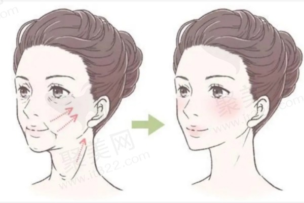 长沙美莱刘欢做面部拉皮手术优势
