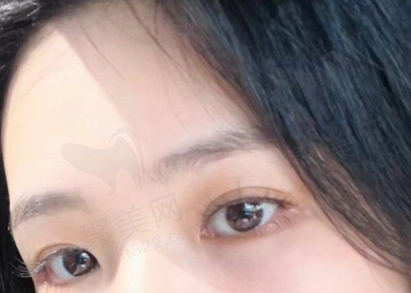 祛眼袋评价