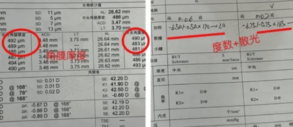 在广州普瑞眼科医院找刘泉做ICL晶体植入术的真实经历