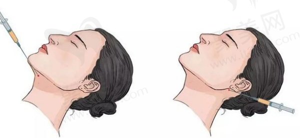 消除双下巴的方法