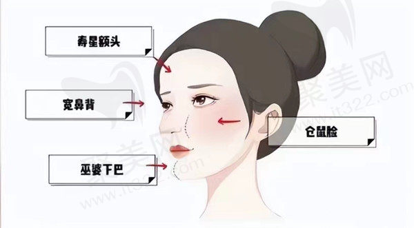 玻尿酸填充过度怎么办？